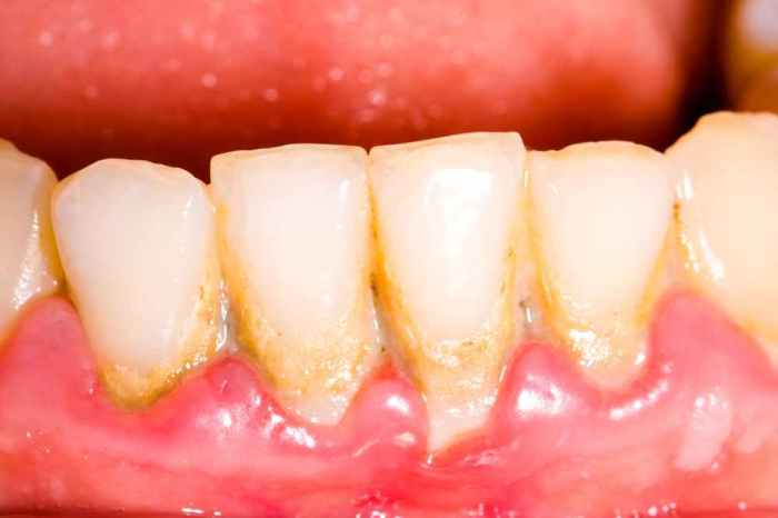 How to care for sensitive teeth and gums